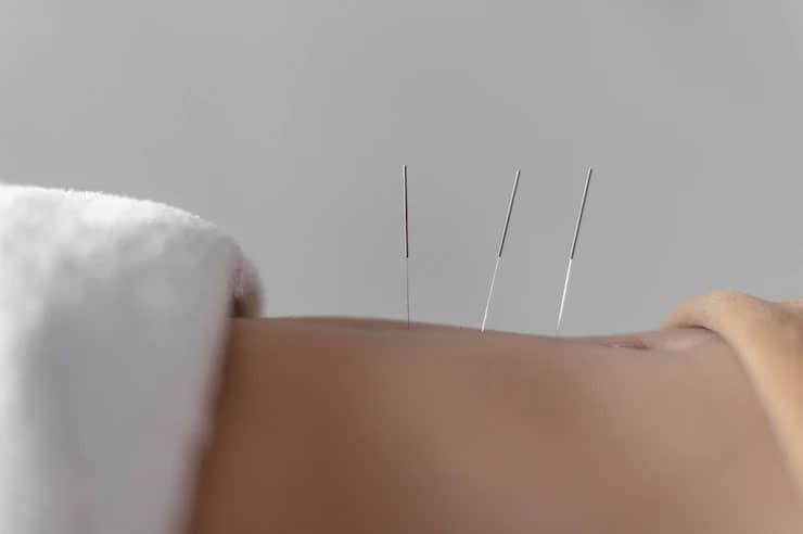 3 Presentes que Podem Ganhar o Dia do Acupunturista
